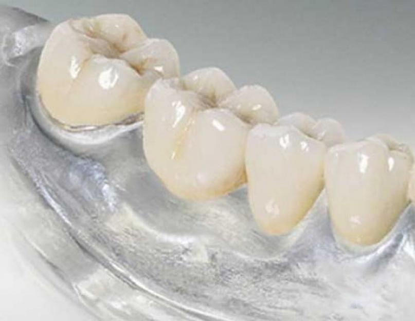 Гибкие протезы зубов. Гибкие зубные протезы, что это такое и какова их характеристика? Новые легкие системы