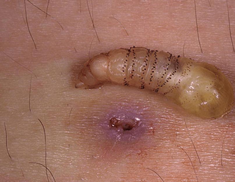 Болезнь вызванная личинками мух — кожный миаз: симптомы и лечение. Миазы