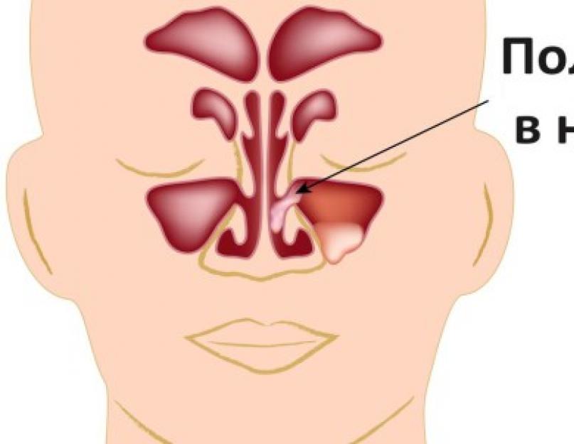 Что делать если нос забит соплями. Насморк и заложенность носа. Полипы в ноздре носа у ребенка.