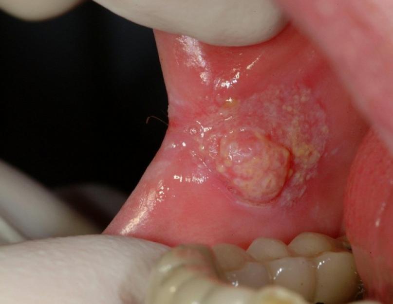 Вирус папилломы человека у женщин во рту. Как выглядят папилломы во рту у человека? От чего появляются наросты и как их удалить? Основные способы заражения вирусом