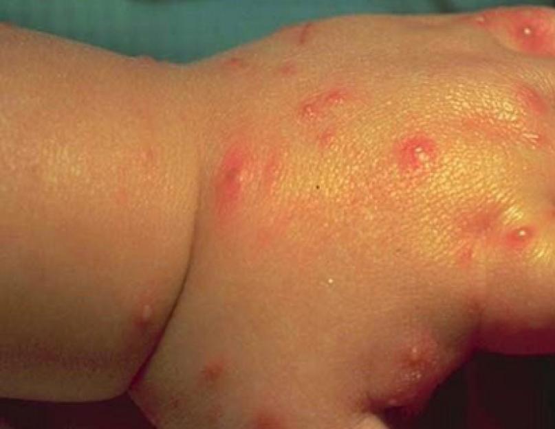 Симптомы малярии после укуса комара у взрослого. Анофелес или малярийный комар: фото, опасность для человека и как избавиться от насекомого