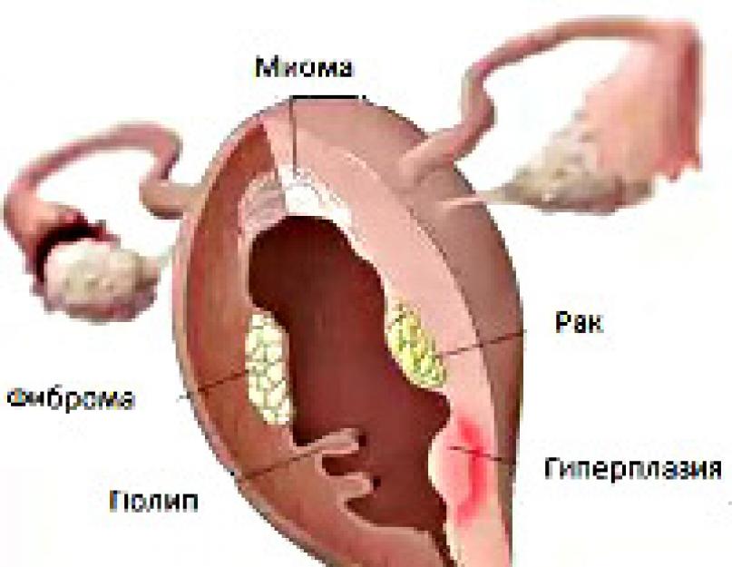 Первые симптомы рака матки и яичников. Признаки рака матки и яичников у женщины