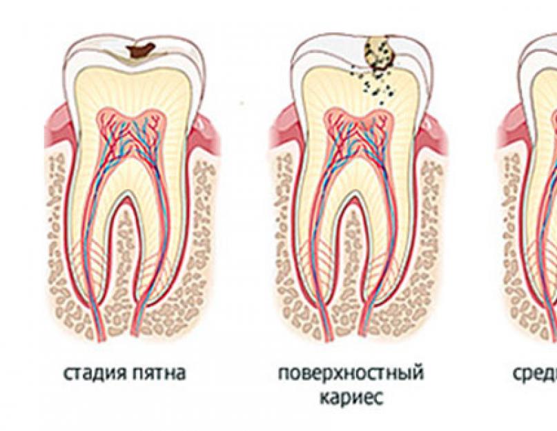 Как справиться сильной зубной болью. Как справиться с зубной болью