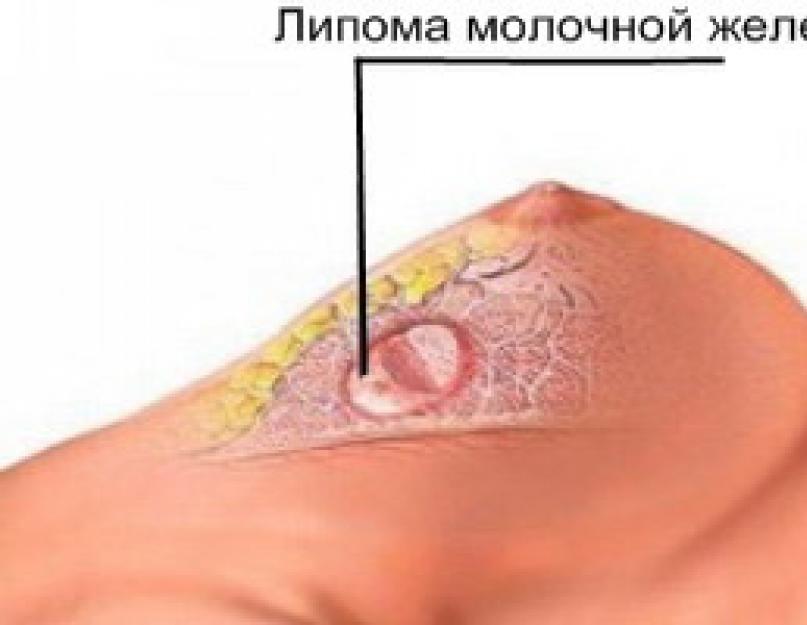Что может расти шишка на грудной клетке. Шишка в груди – что это может быть? Врожденные изменения опорно-двигательной системы