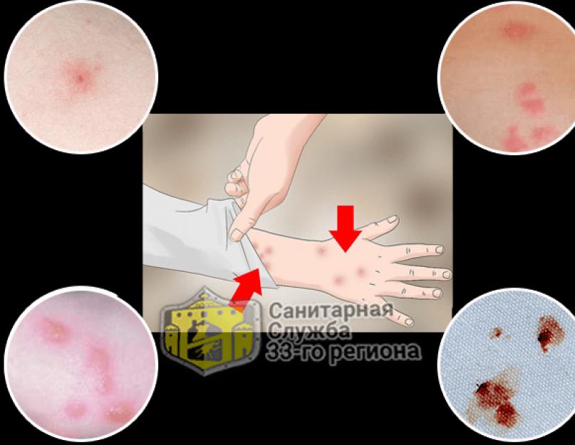 Характерные симптомы при укусах постельных клопов. Как выглядят укусы постельных клопов на коже человека