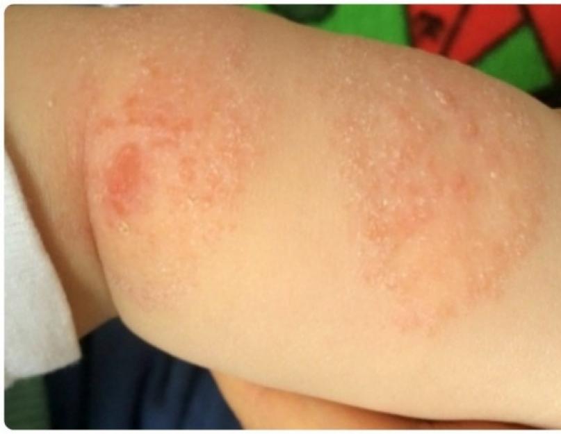 Аллергия у детей и ее признаки. Пищевая аллергия у ребенка Фото