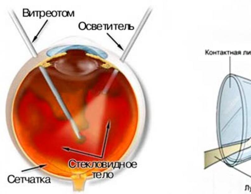 Стекловидное тело операция. Гемофтальм стекловидного тела. Кровоизлияние в стекловидное тело (гемофтальм). Витрэктомия при гемофтальме. Витрэктомия при отслойке сетчатки.